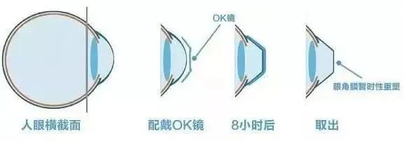 进口医疗器械角膜塑形镜如何报关？